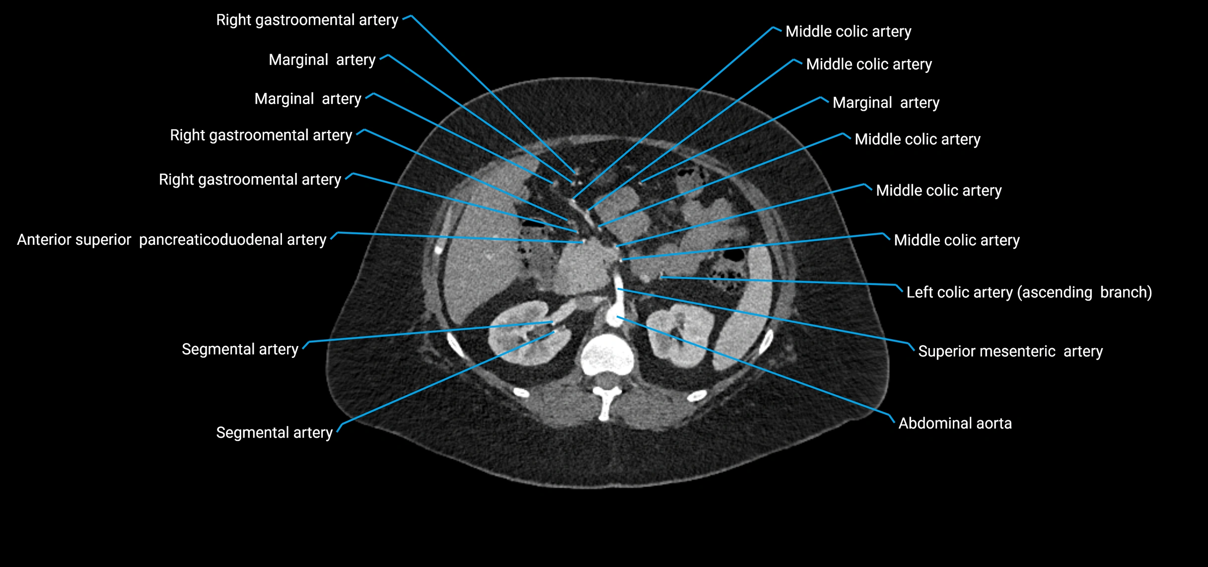 CTA abdomen axial cross sectional anatomy labelled image_66 (2).webp